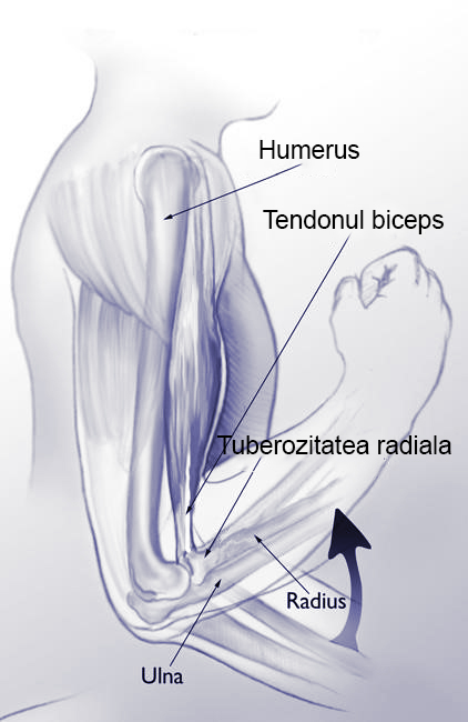 Ruptura tendonului biceps distal