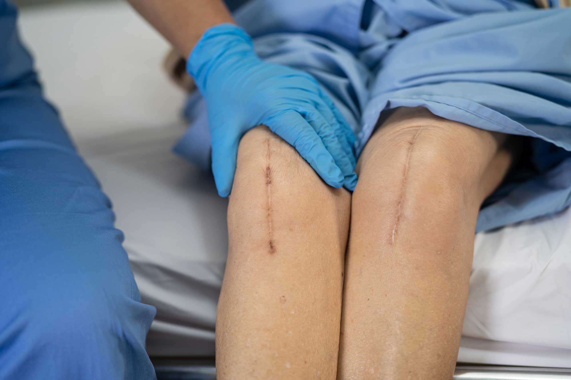 Care sunt efectele ce pot apărea după protezarea totală de genunchi?